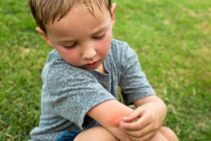 boy with bug bite